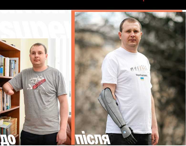 Історії пацієнтів Superhumans Center: військовий Андрій Гідзун